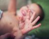الأندلس تسجل ارتفاعاً في الحصبة